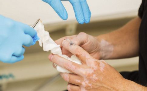 治好白癜风要注意这4项标准,治疗白癜风需要多久的时间