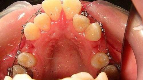 小孩子牙齿不齐多少岁矫正比较好,孩子牙齿不齐什么年龄矫正最合适