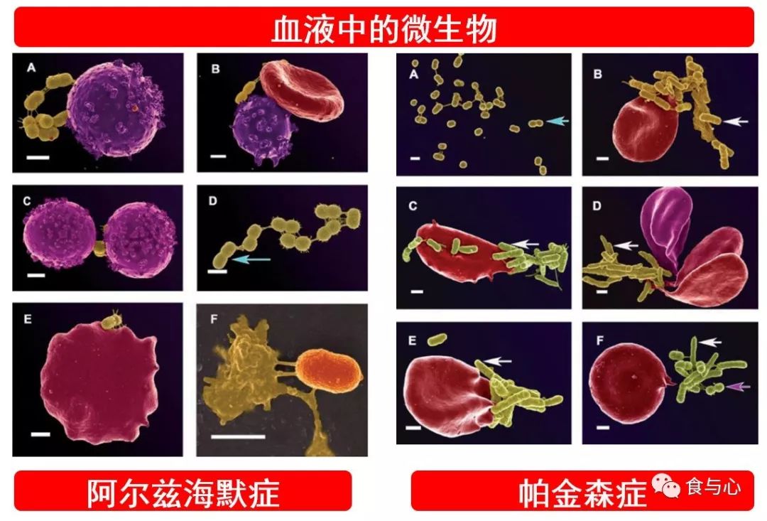 肠漏症的三大指标,肠漏症和脑漏症