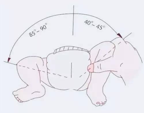 宝宝大腿纹不对称，要做哪些检查？