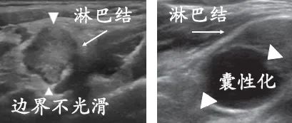 甲状腺术后见异常淋巴结什么意思,甲状腺术后病理有淋巴结转移2枚