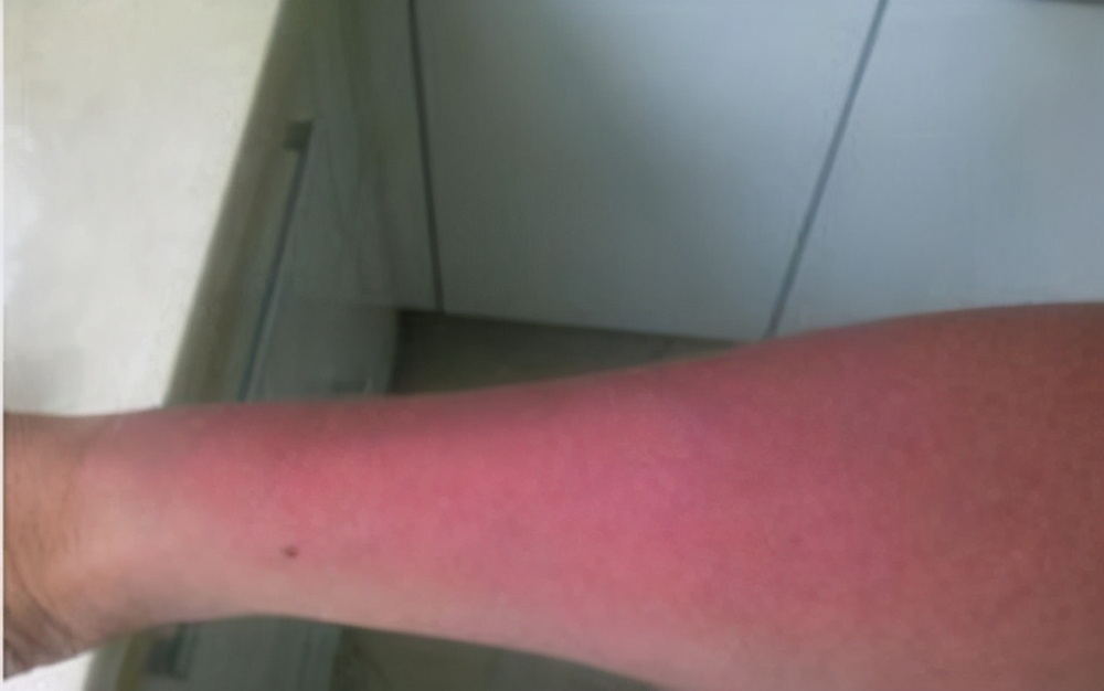 白癜风晒伤后怎样处理好,白癜风晒伤后涂什么药膏