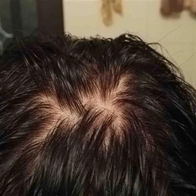 甲亢案例,甲亢治愈后眼球突自救方法