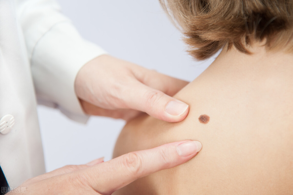 软痣凸起是癌变信号吗,痣变大凸起就一定是要癌变了吗