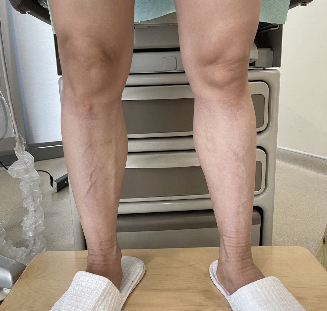 小腿深静脉血栓多久才可以痊愈,深静脉血栓形成的诊断和治疗指南