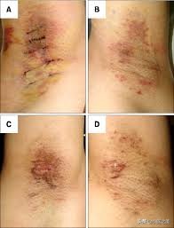 如何治狐臭腋下出汗,腋下轻微出汗有腋臭怎么治