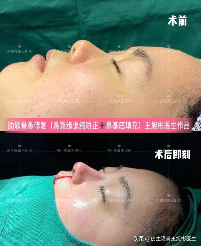 鼻中隔重塑鼻头,鼻中隔重建整形