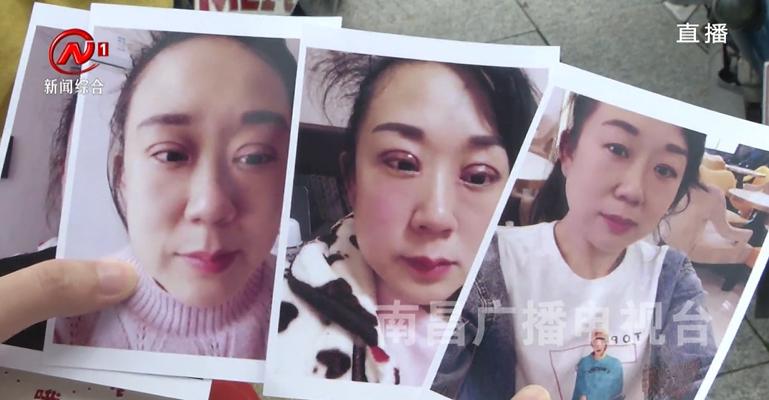 南昌一附院整形科割双眼皮,南昌女子割双眼皮