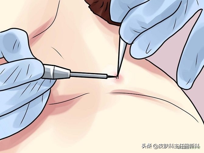 脖子上长皮赘激光后怎么防止复发,脖子上长了小肉粒皮赘擦什么药膏