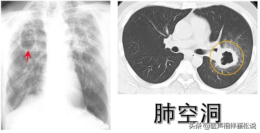 死灰复燃的病例,潜在结核病