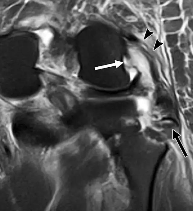 骨折处出现麻痹感,骨折跟精神状态有关