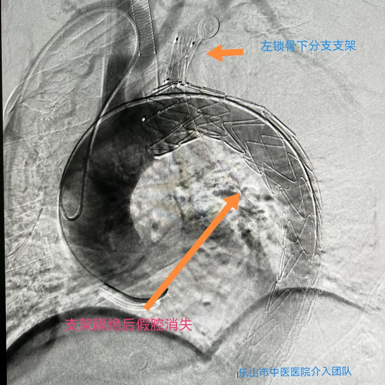 男子头胸藏“定时*弹炸**”我院成功完成一例多个血管夹层动脉瘤手术