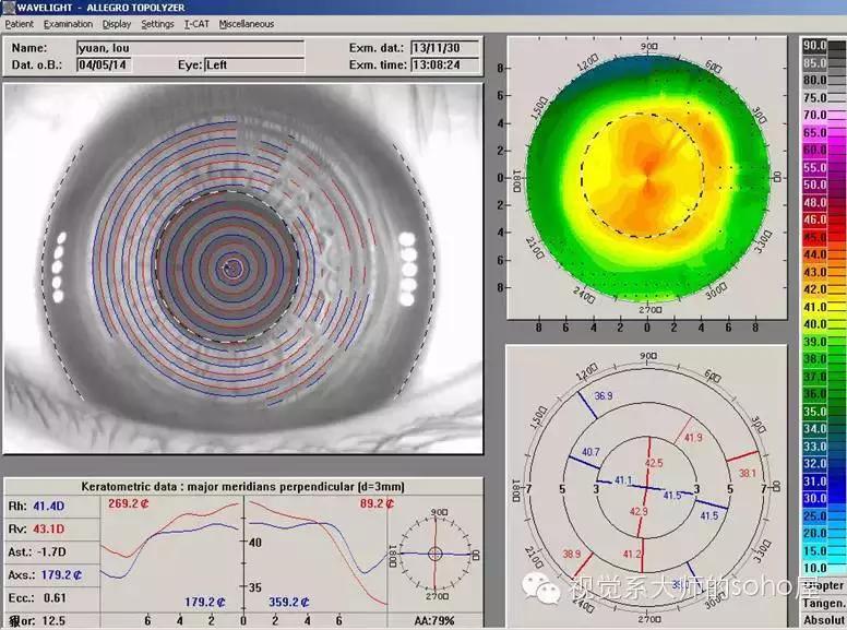 如何选择角膜塑形镜的品牌,怎么选角膜塑形镜的参数