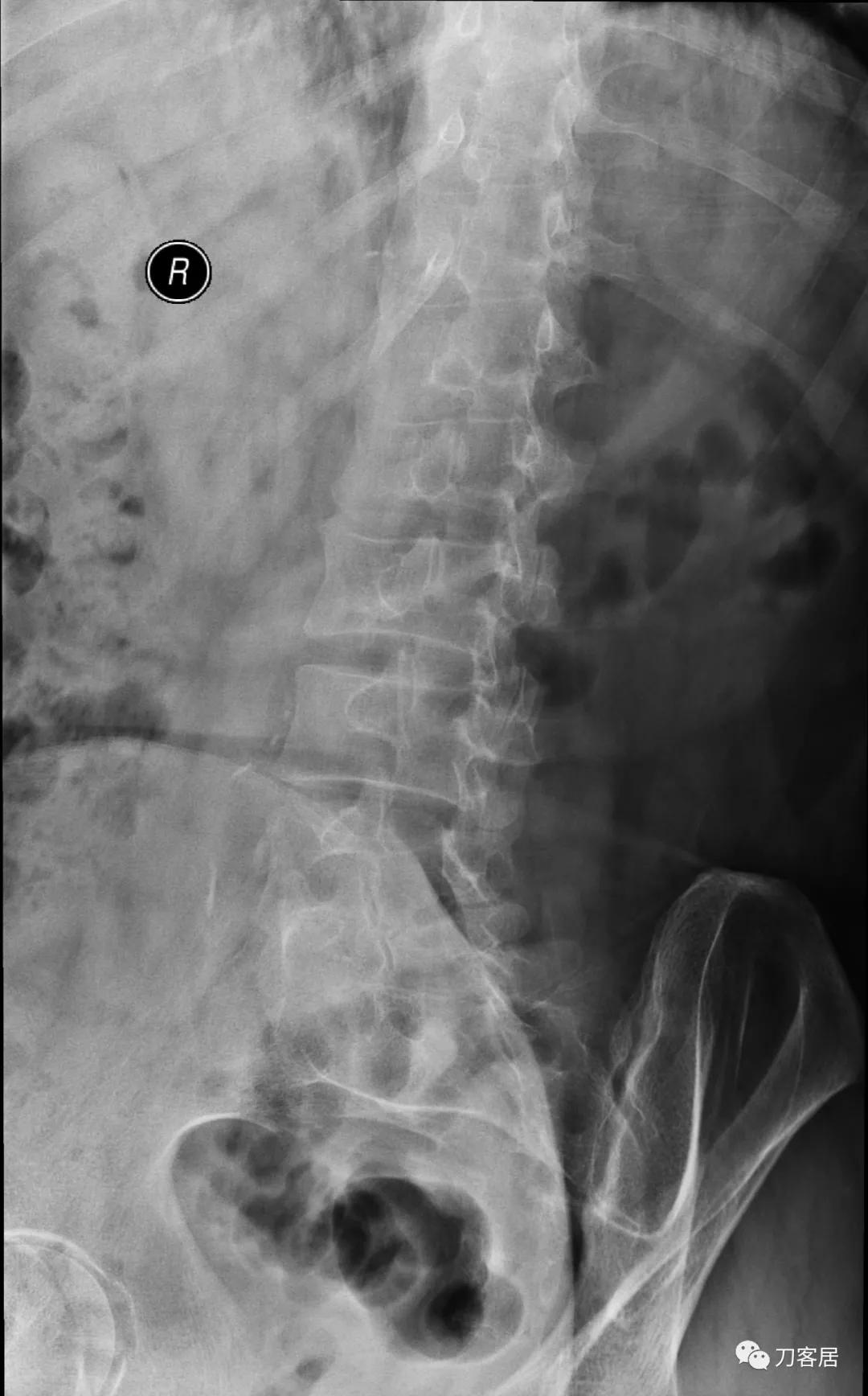 小针刀扎到坐骨神经会瘫痪吗,小针刀会切断坐骨神经吗