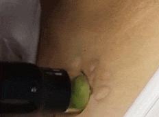 308激光要照多久才能治好,做了308激光后要注意事项