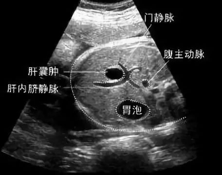 体检查出肝囊肿怎么办医生来教你,体检有肝囊肿怎么办