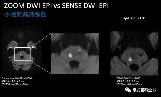 dwi成像序列,dwi序列和edwi序列