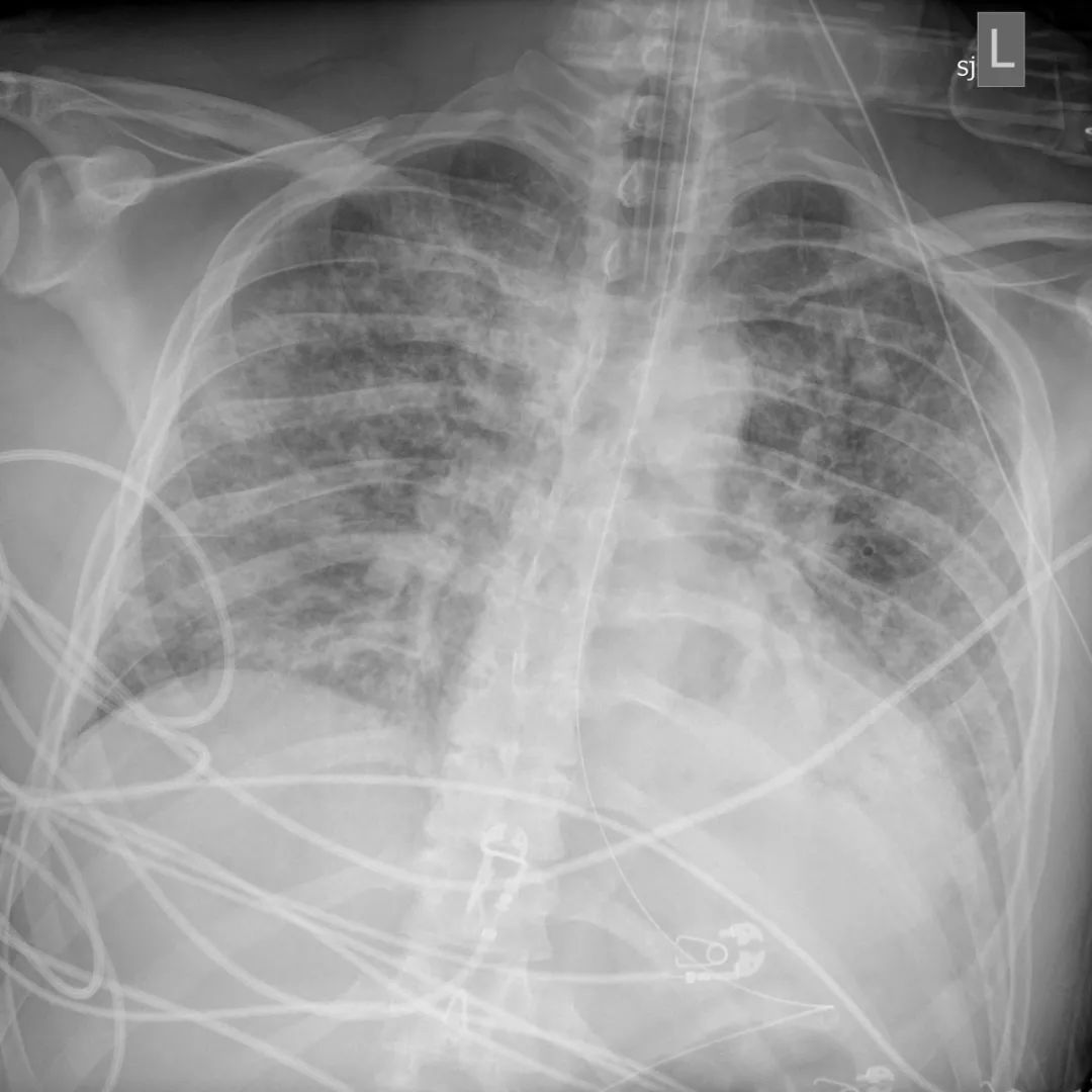 瑞德西韦治疗埃博拉病毒,瑞德西韦新冠药