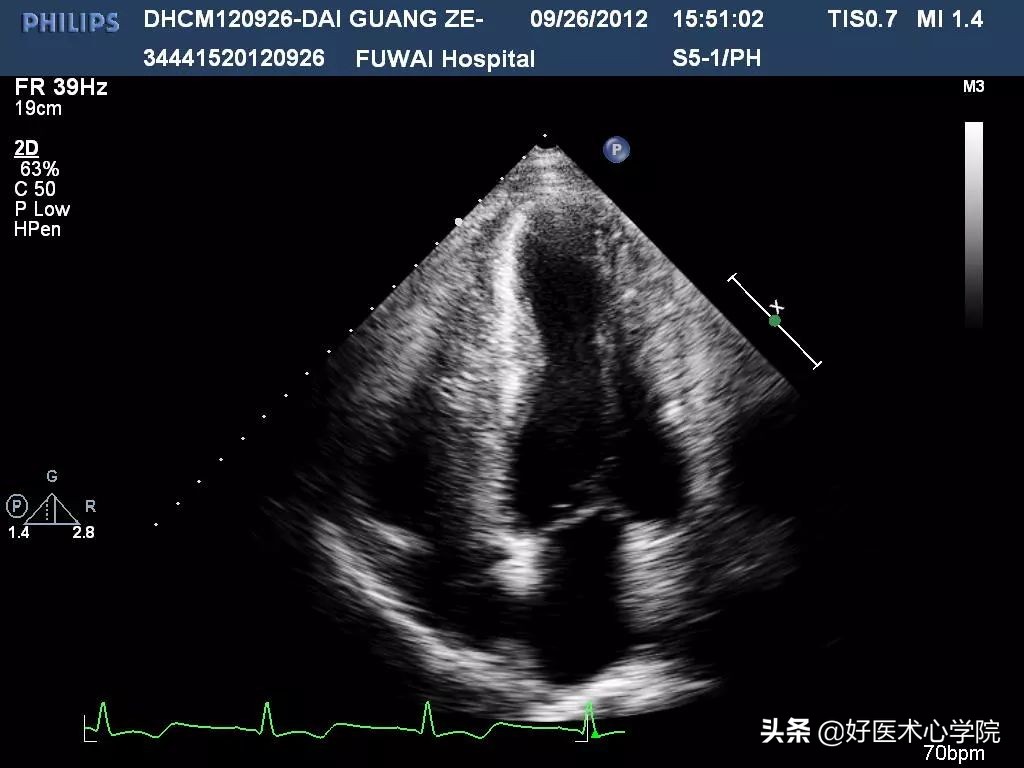肥厚性心肌病伴心肌梗死,心尖部室壁瘤和心肌穿孔能救活吗