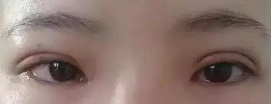 双眼皮修复为什么更贵,双眼皮修复是怎么做的