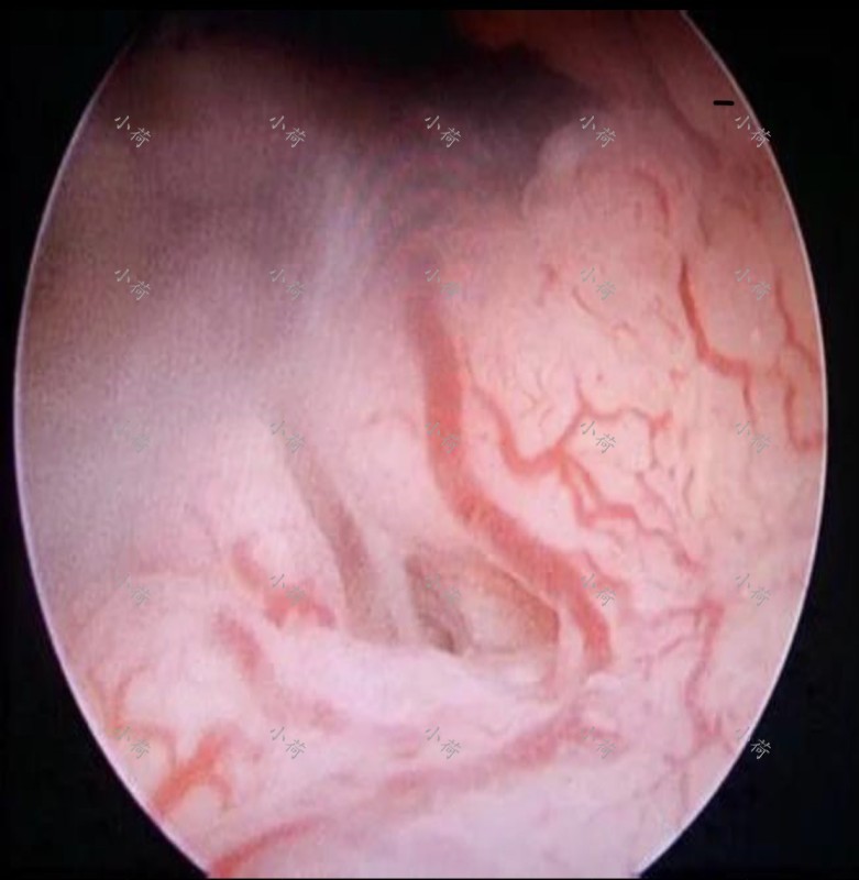 八十岁老人得了子宫内膜癌,糖尿病人内膜癌治疗方法