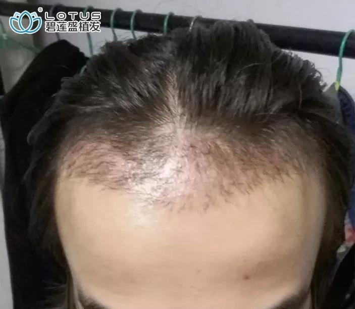 发际线后移额角大头发稀疏怎么办,额角发际线还能恢复吗