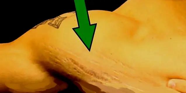 健身过程中长出了生长纹该怎么办,不合理健身导致手臂生长纹怎么办