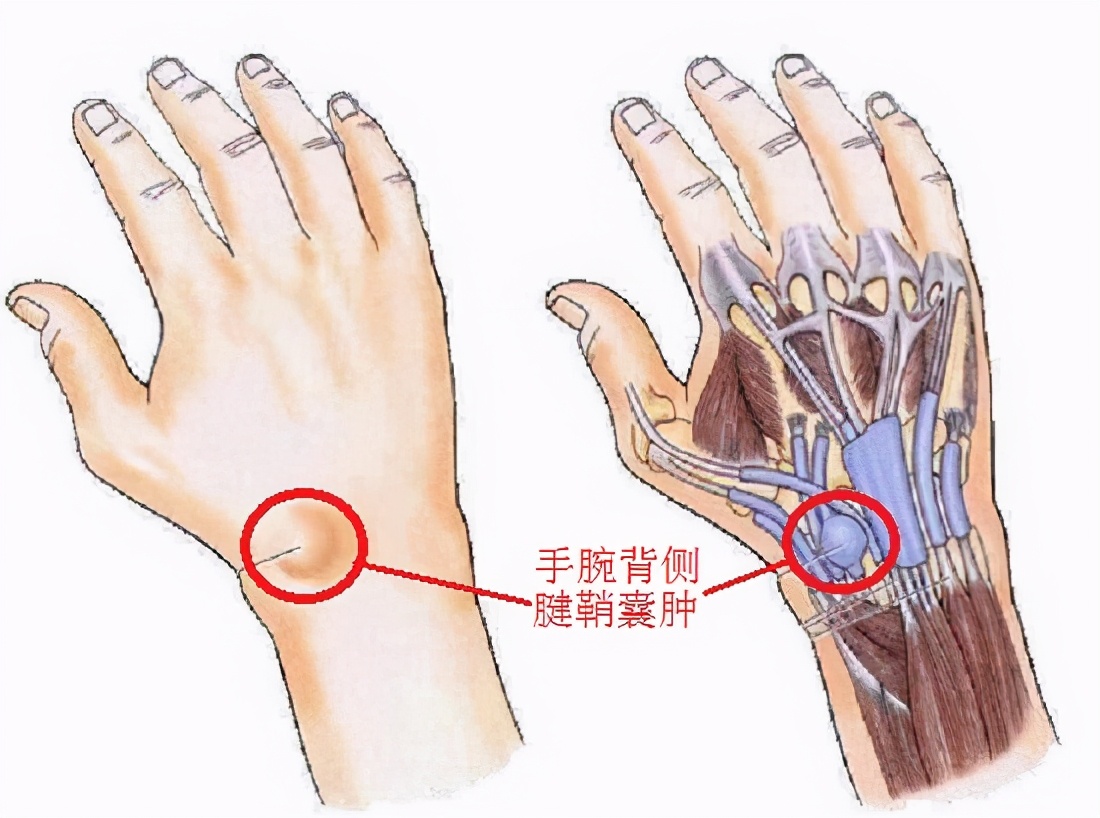 腕部腱鞘囊肿摘除术后康复