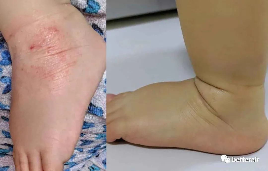宝宝湿疹咳嗽流涕减轻,宝宝湿疹反复奇痒难忍