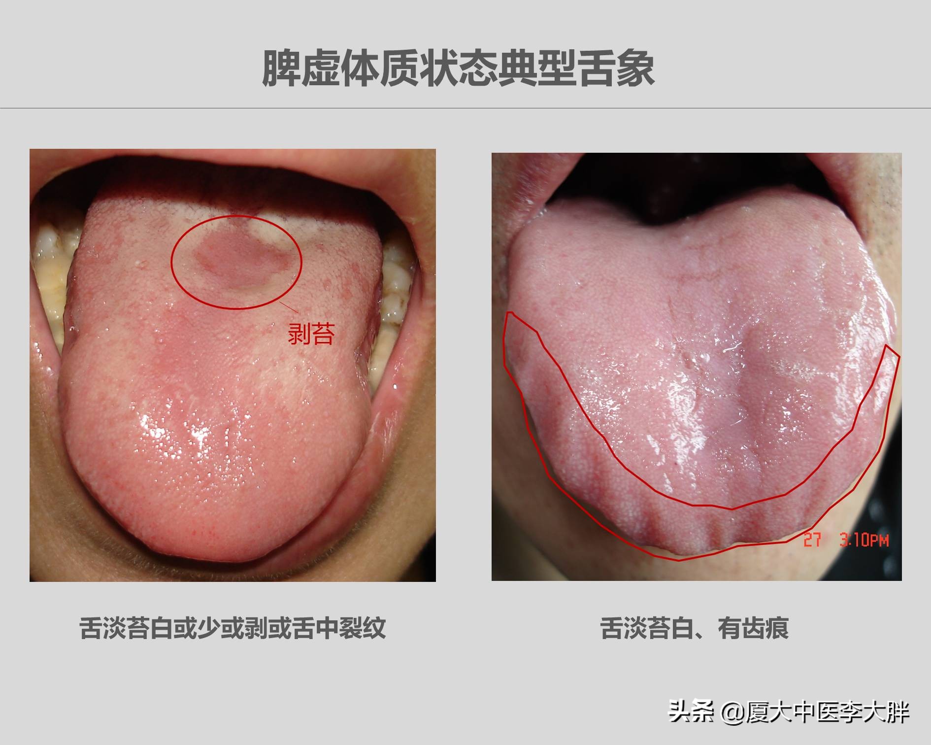 幽门螺旋杆菌哪些必须治疗,什么食疗方法治疗幽门螺旋杆菌