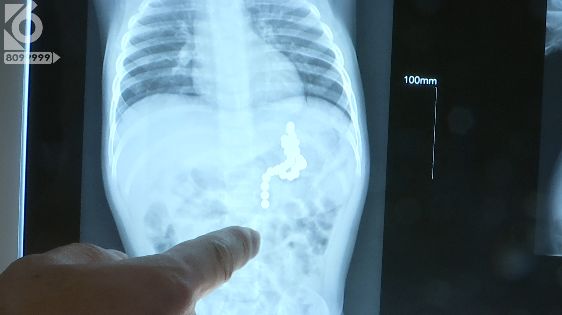 幼儿误吞磁力珠致小肠穿孔,女孩误吞磁力珠致6处肠穿孔