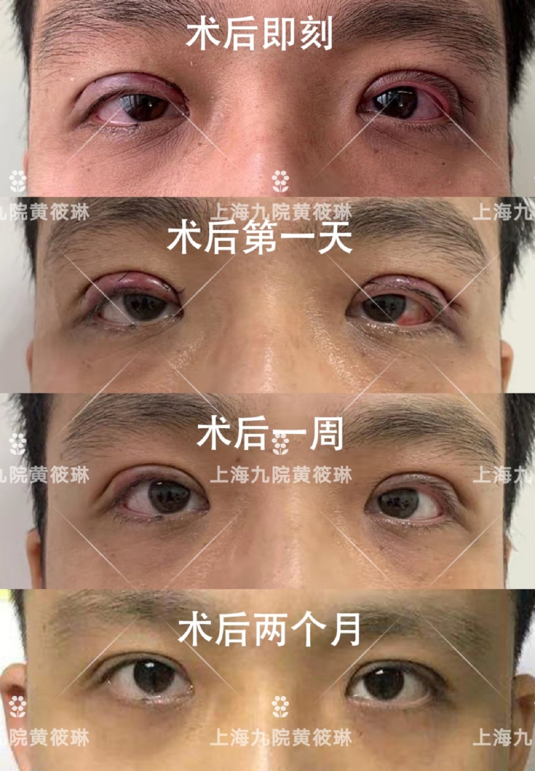 男生双眼皮跟女生有什么区别,男生双眼皮和女生双眼皮区别