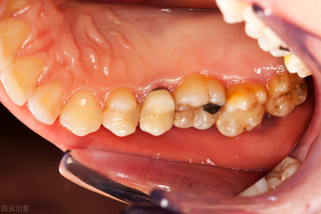 智齿牙龈发炎肿痛怎么办吃什么药,上火牙龈肿痛吃什么药可以治疗啊