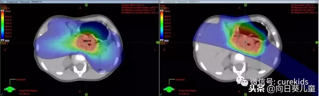 质子治肿瘤怎么样,儿童肿瘤质子治疗好吗