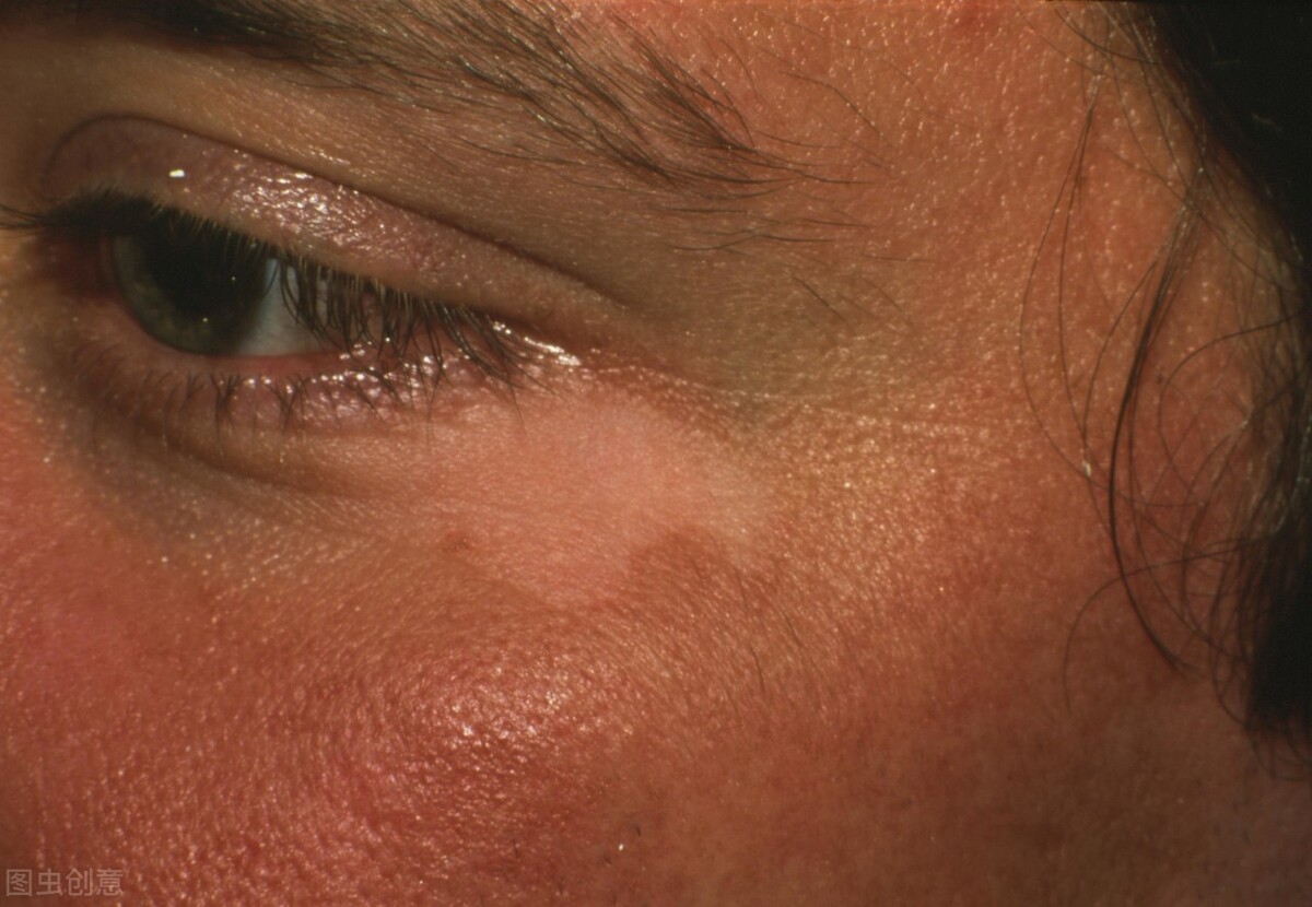 白癜风治疗期间会继续长出白斑吗,服药期间白癜风扩散