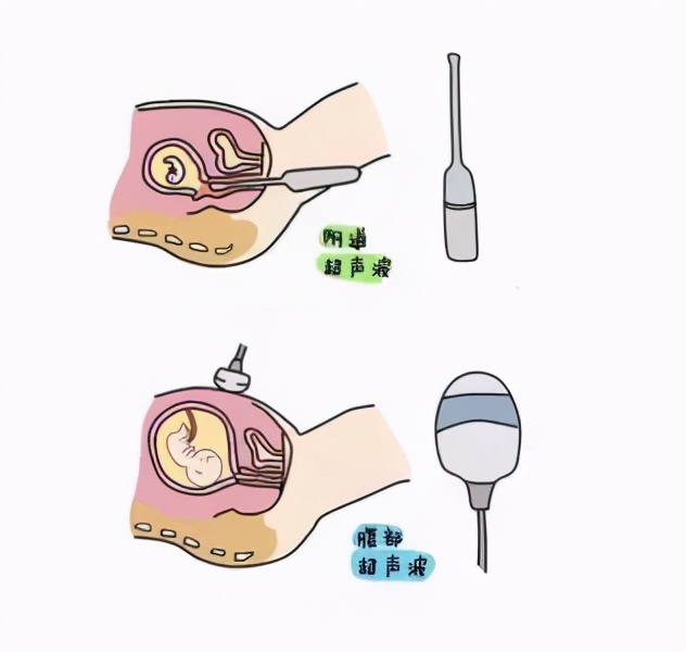 早孕还能吸腹吗,早孕还能做阴超吗