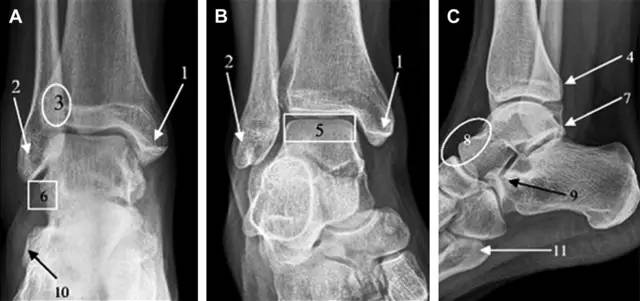 常见的八种骨折,容易漏诊的肩关节骨折