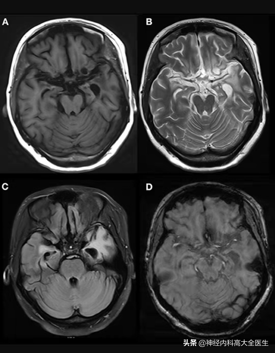 抗gaba受体脑炎临床表现轻,抗gababr抗体脑炎死亡率