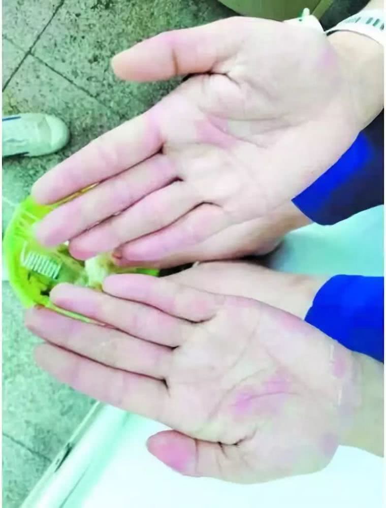 江门新会一少女天天吃鱼，手脚竟“满目疮痍”！医生一句话说出真相