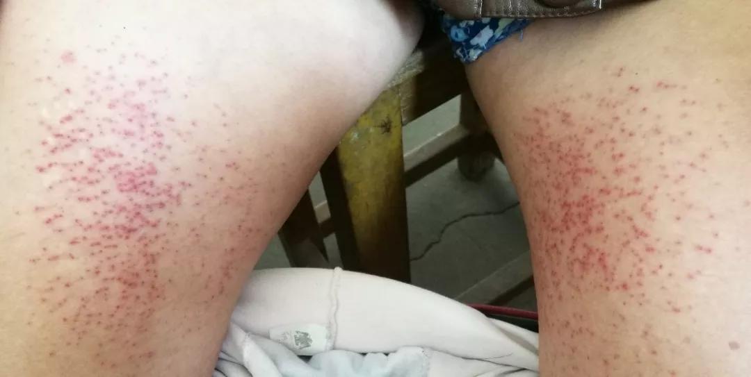 精神紧张焦虑湿疹皮炎就复发,湿疹皮炎总是复发