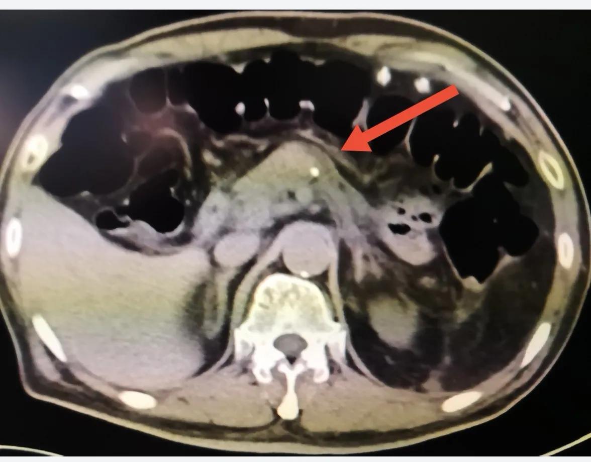 腹腔镜胰体尾切除术打孔位置,胰体尾肿瘤切除后复查哪些