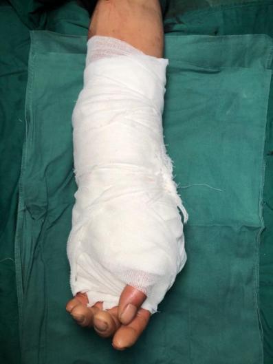 手臂离断再植,手臂断离再植