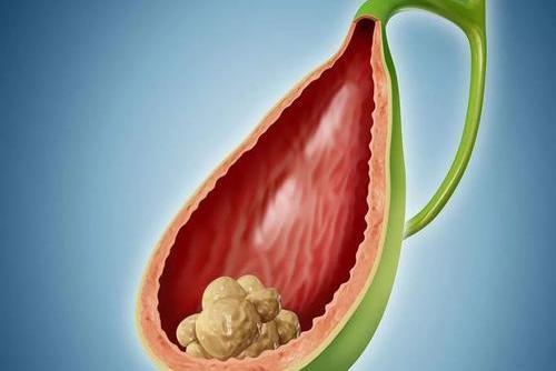 70岁人做肝胆结石手术能做吗,肝胆结石不做手术的后果是什么