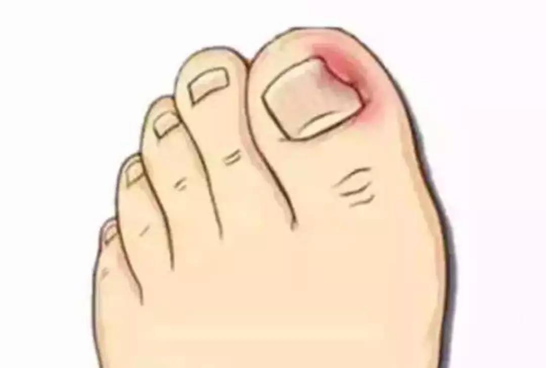 勤修脚能治好甲沟炎吗,勤剪指甲卫生常识