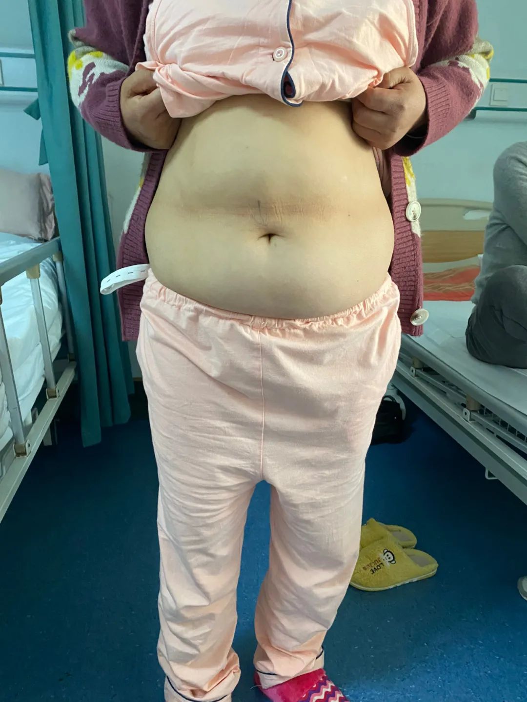 国际首创！武汉大学人民医院（湖北省人民医院）实现达芬奇机器人+人体自然腔道完成“无痕”直肠癌根治