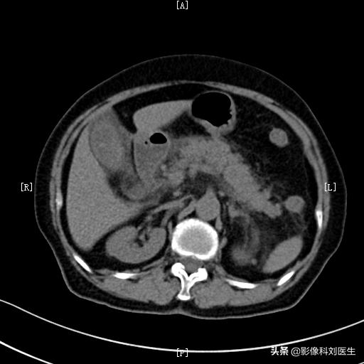 暴饮暴食导致胃脘胀满疼痛,暴饮暴食引起的腹部疼痛怎么缓解