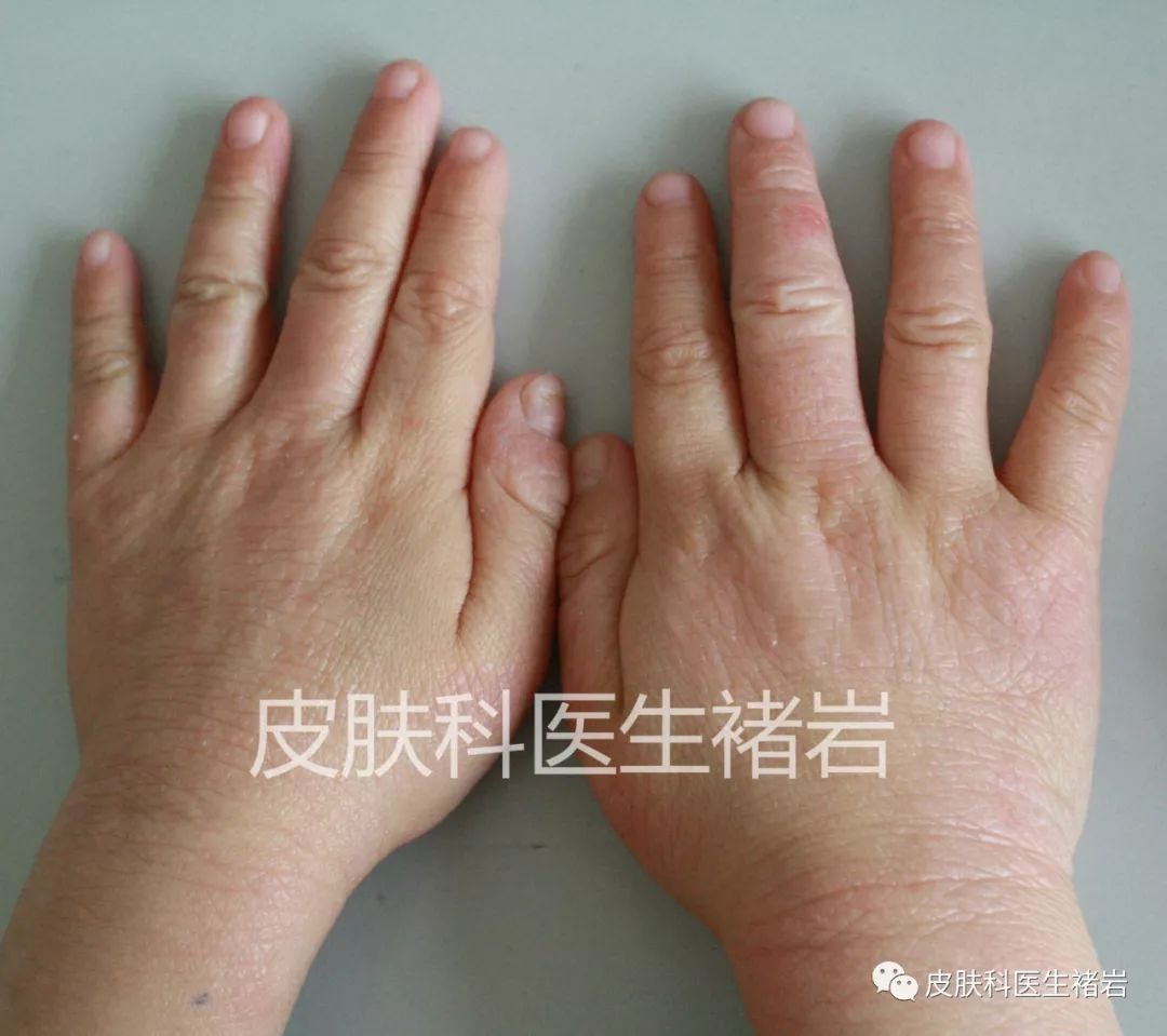 湿疹到底长什么样,手脚湿疹长什么样