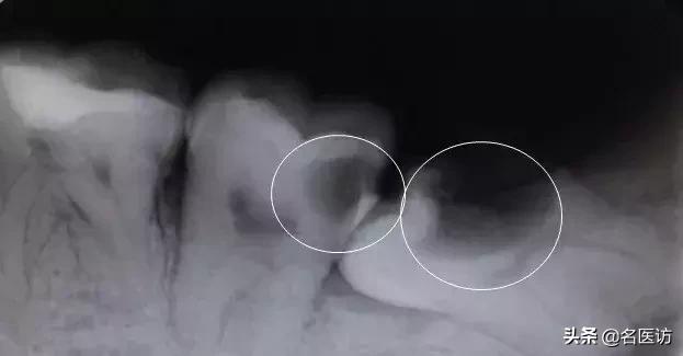 拔智齿有什么禁忌吗,拔智齿有什么禁忌