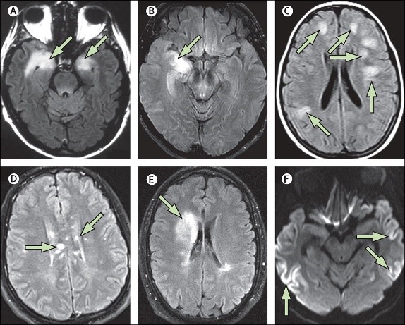 儿童脑炎引起癫痫吃什么药控制,小孩脑炎惊厥怎么办