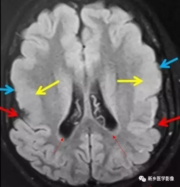 脑室影像学表现,脑室占位影像